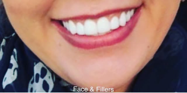 Before treatment at Wellface Cobham