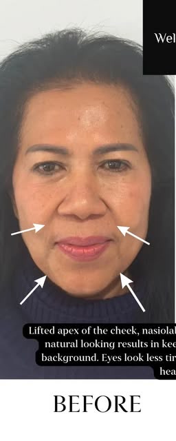 Before treatment at Wellface Cobham
