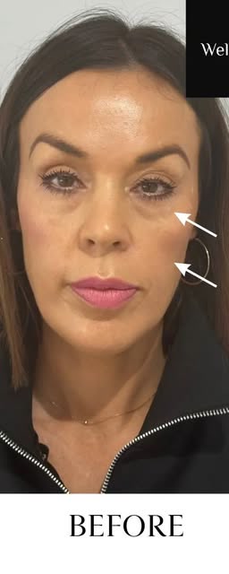Before treatment at Wellface Cobham