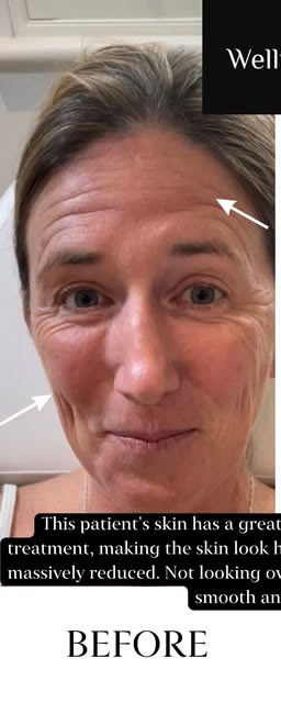 Before treatment at Wellface Cobham