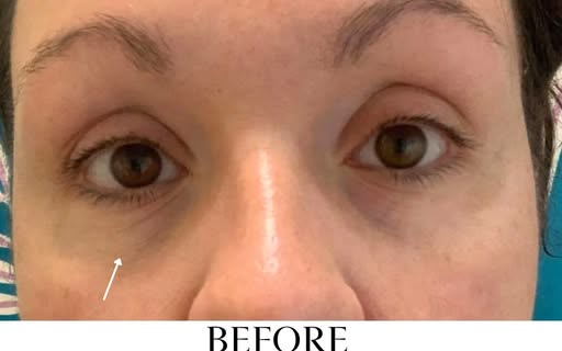 Before treatment at Wellface Cobham