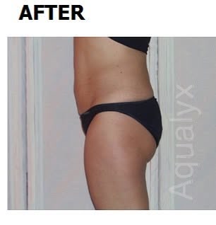 After: Aqualyx abdomen fat loss at Wellface