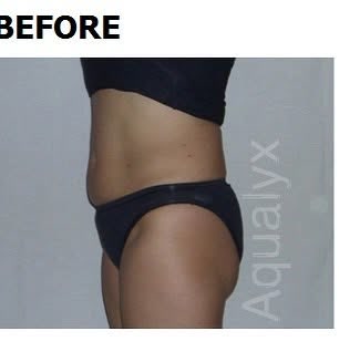 Before: Aqualyx abdomen fat loss at Wellface