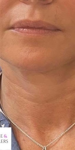 After treatment at Wellface Wimbledon