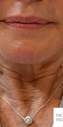 Before treatment at Wellface Wimbledon