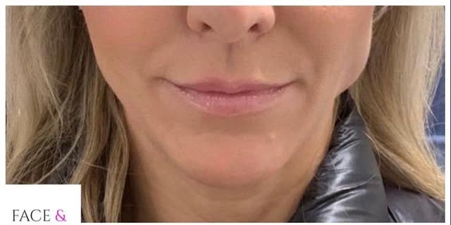 Before treatment at Wellface Wimbledon