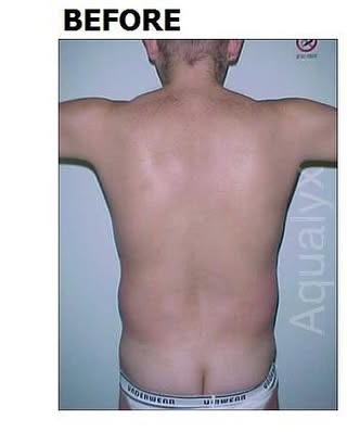Before: Aqualyx fat dissolving, back and flank, at Wellface