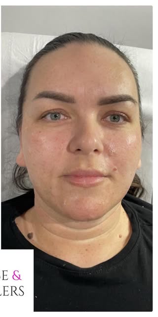 After treatment at Wellface Cobham