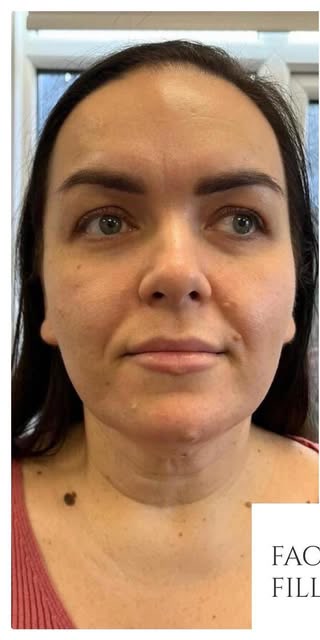 Before treatment at Wellface Cobham