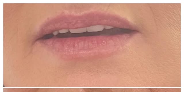 Before treatment at Wellface Cobham