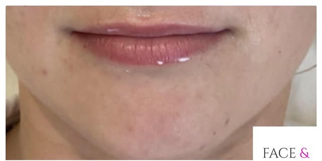 Before treatment at Wellface Cobham