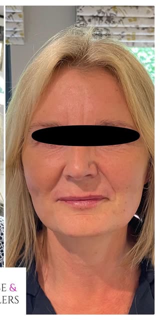 After treatment at Wellface Cobham