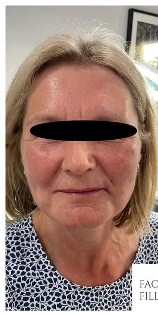 Before treatment at Wellface Cobham
