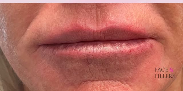 After treatment at Wellface Cobham