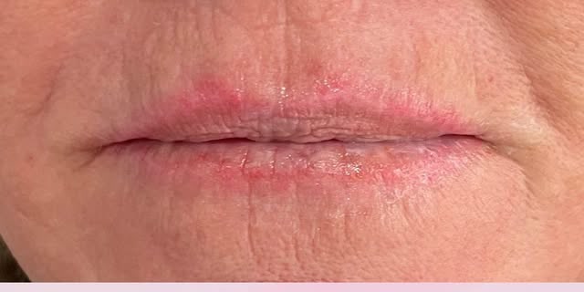 Before treatment at Wellface Cobham