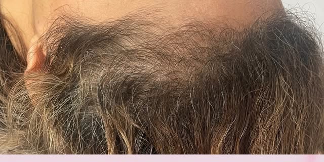 Before treatment at Wellface Cobham