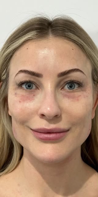 Before treatment at Wellface Cobham