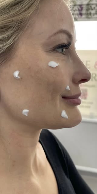 Before treatment at Wellface Cobham