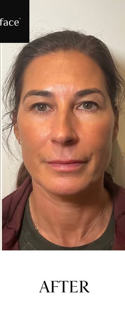 After treatment at Wellface Cobham