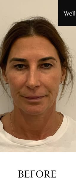 Before treatment at Wellface Cobham
