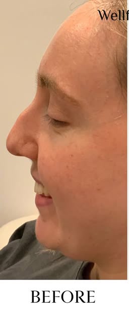 Before treatment at Wellface Cobham