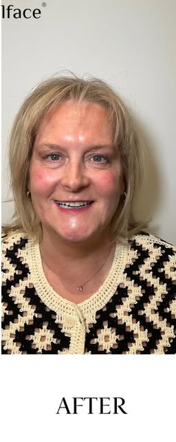 After treatment at Wellface Cobham