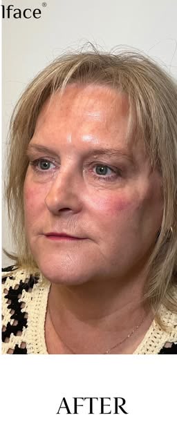 After treatment at Wellface Wimbledon