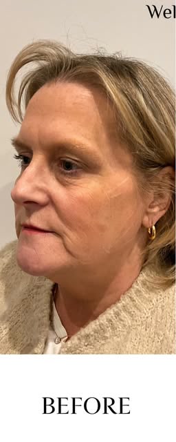 Before treatment at Wellface Wimbledon