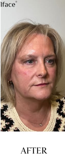 After: Lower face rejuvenation result at Wellface