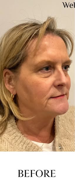 Before: Lower face rejuvenation result at Wellface