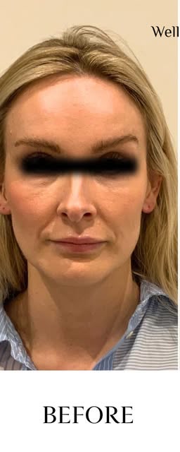 Before treatment at Wellface Cobham