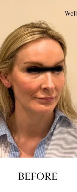 Before treatment at Wellface Cobham