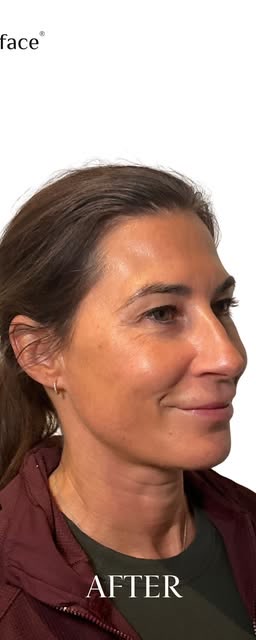 After treatment at Wellface Wimbledon