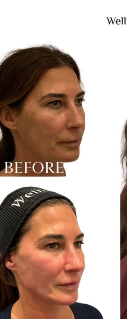 Before treatment at Wellface Wimbledon
