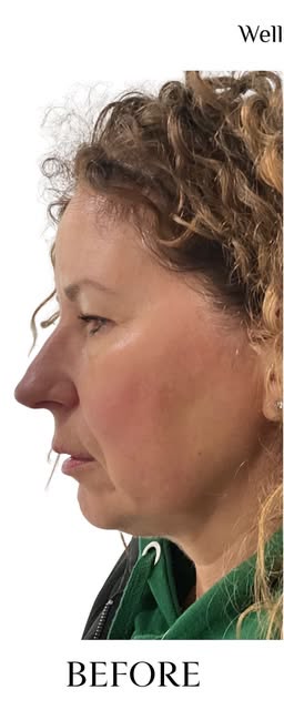 Before treatment at Wellface Cobham