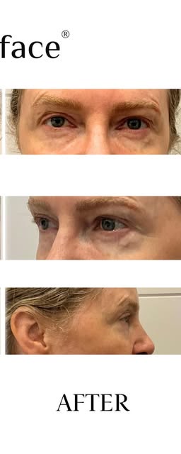 After treatment at Wellface Wimbledon