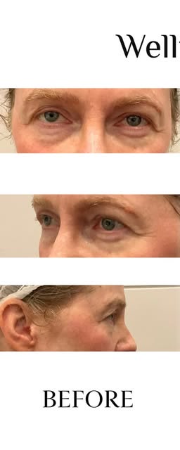 Before treatment at Wellface Wimbledon