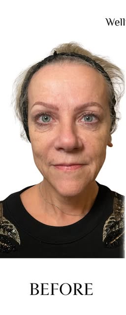 Before treatment at Wellface Cobham