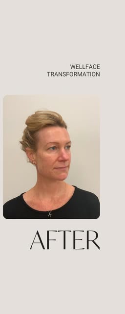 After treatment at Wellface Cobham