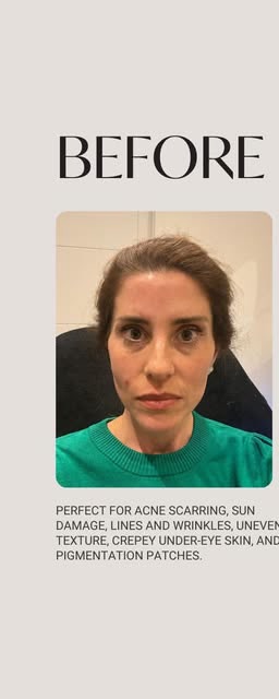 Before treatment at Wellface Wimbledon