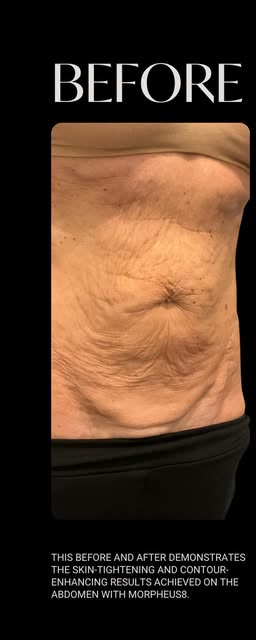 Before treatment at Wellface Wimbledon