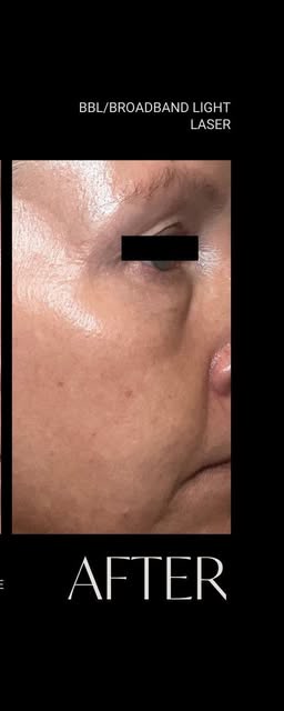 After treatment at Wellface Wimbledon
