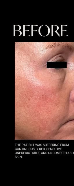 Before treatment at Wellface Wimbledon