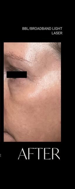 After treatment at Wellface Wimbledon