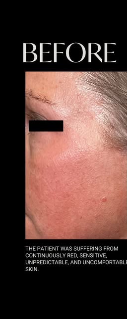 Before treatment at Wellface Wimbledon