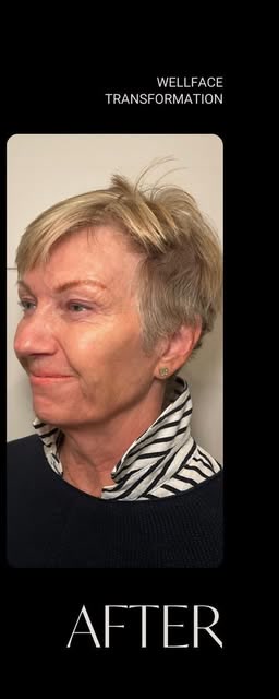 After treatment at Wellface Cobham