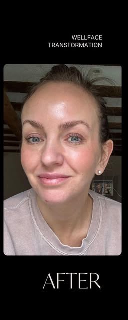 After treatment at Wellface Cobham