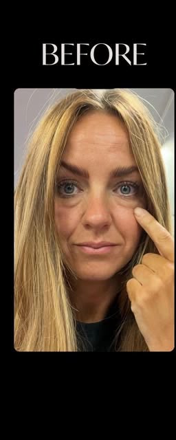 Before treatment at Wellface Cobham