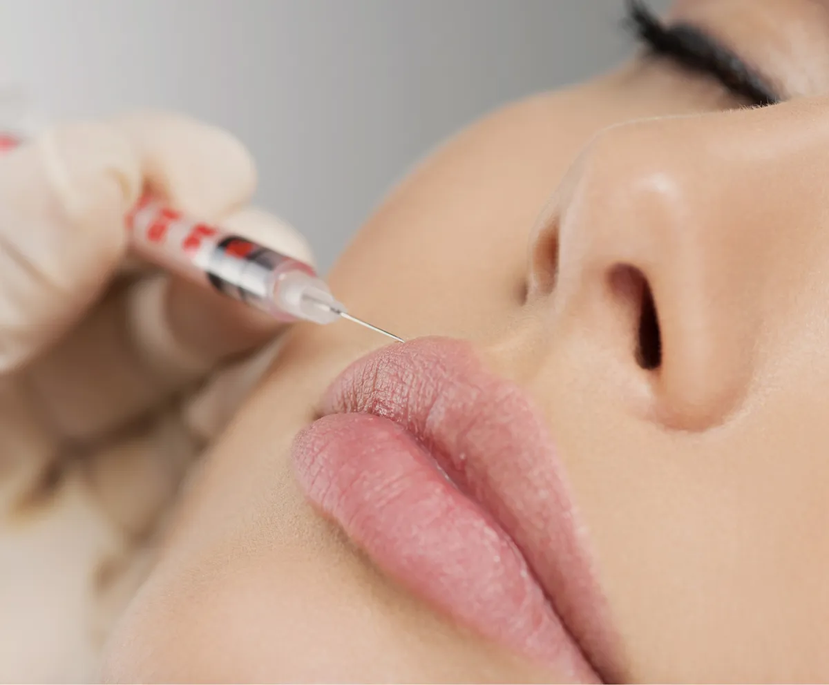 Lip filler treatment at Wellface