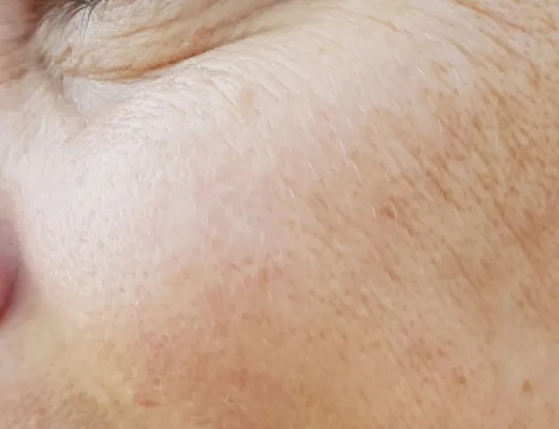 Skin texture and tone treatment at Wellface